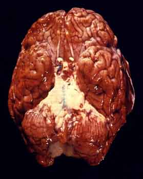 The Brain of meningitis